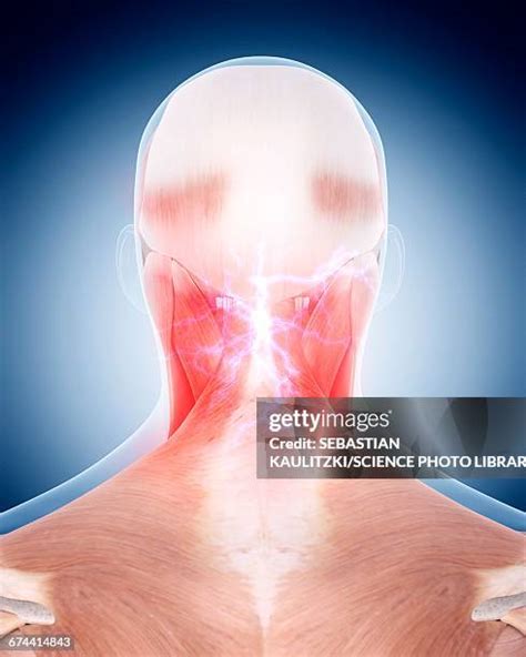 Neck Muscle Pain Illustration Photos and Premium High Res Pictures ...