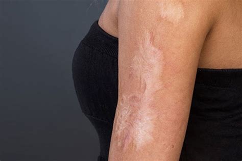 scars form posas