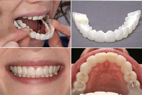 Купить виниры для зубов snap on smile по цене 750 руб. в интернет ...