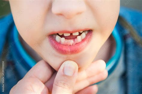 Close up of open mouth of little caucasian child with growing new teeth. Stock Photo | Adobe Stock