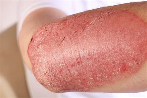 Ixekizumab Leads to Earlier Skin Clearance Than Guselkumab in Patients ...