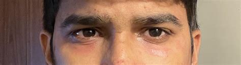 Allergy due to Salicylic Acid : r/IndianSkincareAddicts