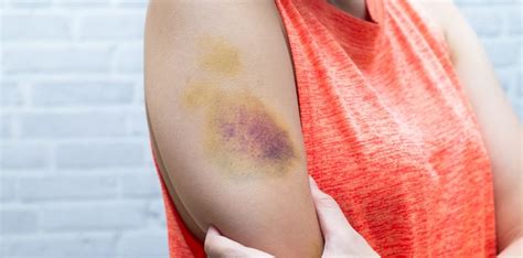 How to Prevent Bruising: Causes and Remedies for Bruising