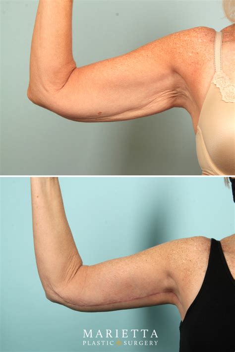 Transform Your Arms with Brachioplasty