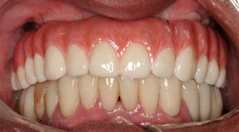 Fixed Dental Implants