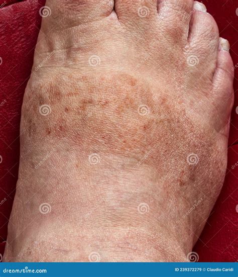 Manchas Escuras Nos Pés E Tornozelos - Manchas Escuras E Pele Desidratada Nos Pés Do Homem. Conceito De ...