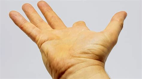 Hand of a Person with a Part of the Index Finger Missing Due To a Prior Injury Stock Image ...