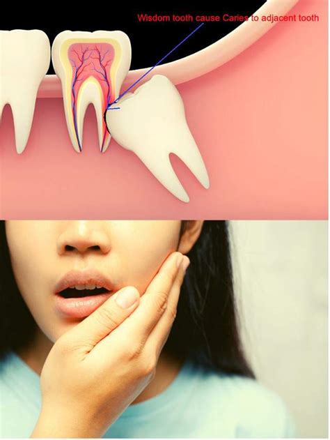 Wisdom tooth Infection Symptoms » www.medihelp365.com