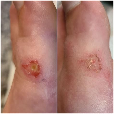 I asked if this was a recluse bite yesterday but something is NOT right