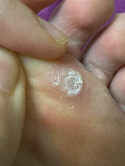 Corn? Wart? 4 year old puncture wound : r/Warts