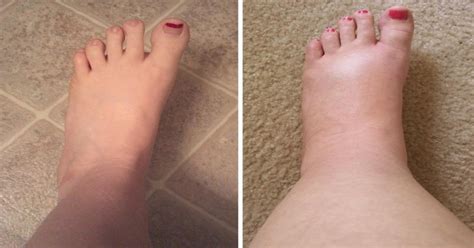 Are your ankles and feet swollen? Then you may have Ankle Oedema ...