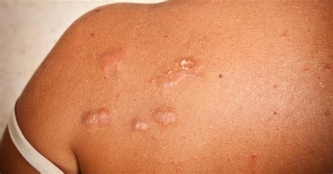 Keloid Scars: Symptoms, Causes, Prevention & Treatment