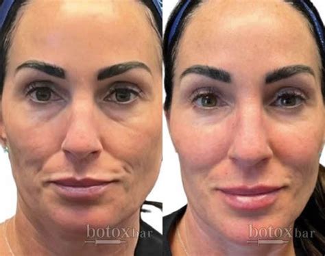 Cheek Filler Injection Plano, TX | Botox Bar