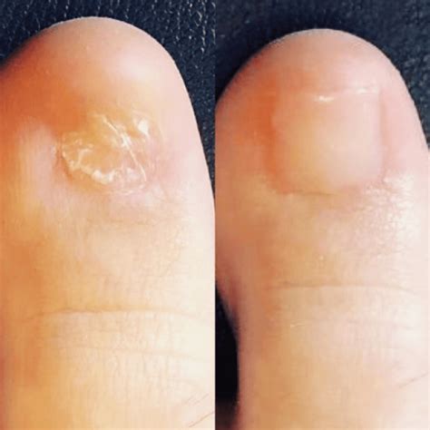 5 Little-Known Tips To Rescue Ravaged Toes