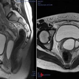 Tumor in the vaginal canal in a female patient at 30.1 weeks of