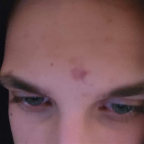 Plötzlich roter Fleck im Gesicht? (Gesundheit und Medizin, Haut)