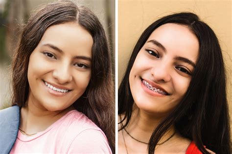 What to Expect When Getting Braces to Fix Your Overbite