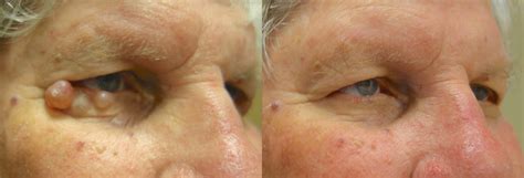 Eyelid Growth Removal Archives - In Focus Ophthalmic Plastic Surgery