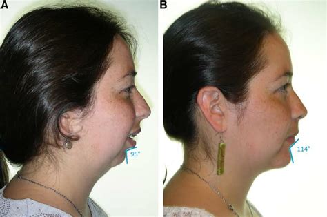 lateral view. Before (a) and after (B) l1 (impaction surgery), BSSrO ...