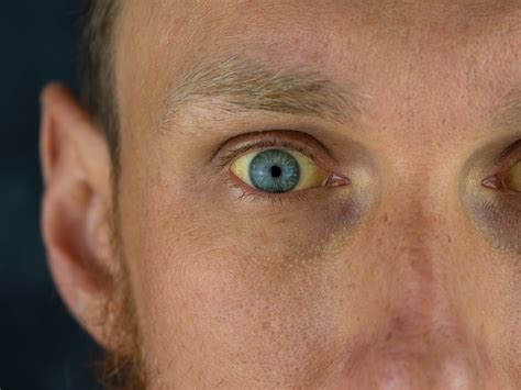 Olhos Amarelados O Que Pode Ser - Olhos amarelados: o que pode ser essa condição? - Blog Unimed Rio Preto