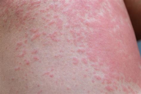 skin irritation treatment  common rashes  kids  preschoolers