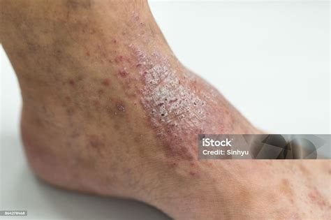 Dermatite Atópica No Pé - Foto de Dermatite Atópica Em Pé e mais fotos de stock de Alergia - iStock