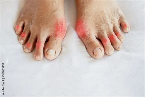 Home Remedies for Gout | Board Certified Podiatrist Foot & Ankle ...