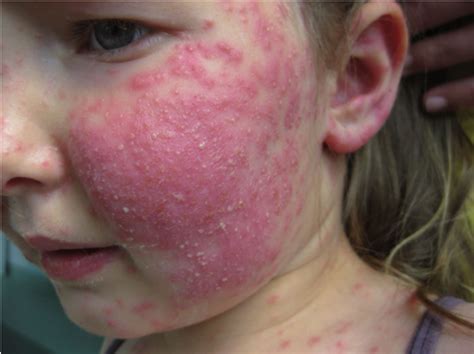 pustule skin lesions  face nose body hands feet