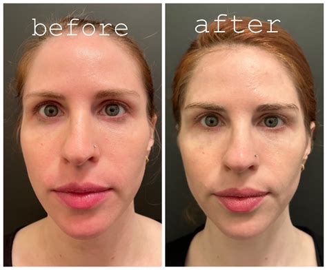 Unbelievable Blackhead Removal 2024: My Honest Review & Before/After Pics. Image 4
