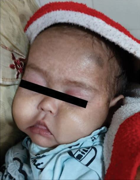 genetic inheritance  tandem  syndromic autosomal recessive
