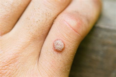 Can treating warts do more harm than good? | Dermatology Times