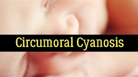 39 Awesome Circumoral Cyanosis Treatment - insectza