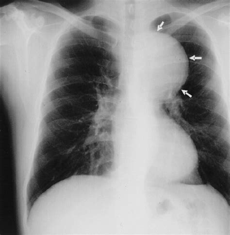 Giant Aortic Aneurysm After Patch Repair of Coarctation | Circulation