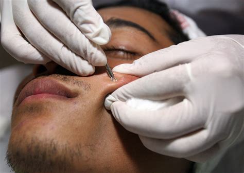 Giant Pimples Popped