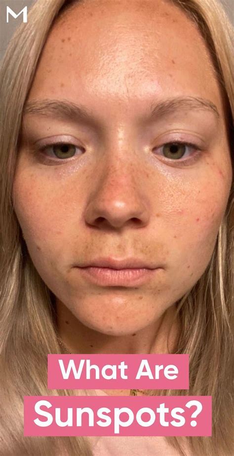 Sunspots on skin causes and treatment – Artofit