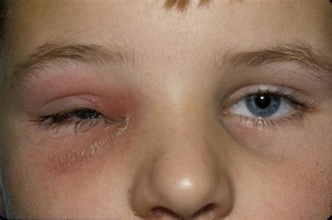 Eye Infection: Top Symptoms and Effective Treatment Options