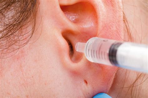 Ear Wax Removal: When to See a Doctor