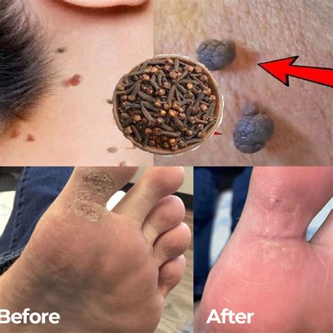 how to remove skin tags in one night naturally