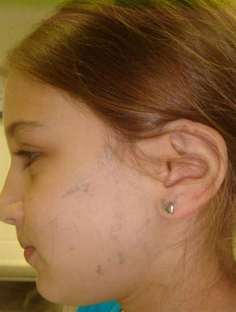 tattoo removal works tattoo removal somalaser