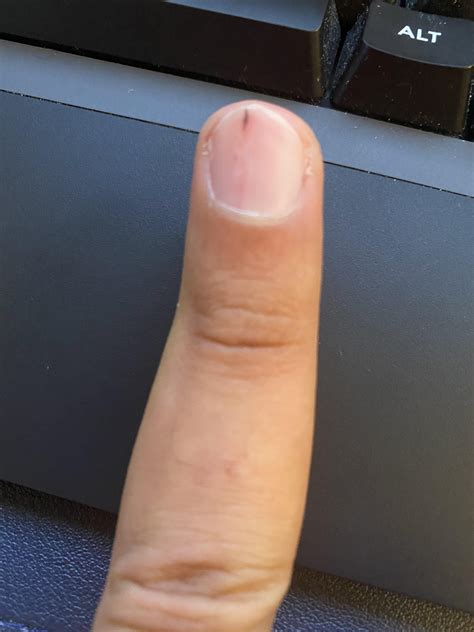 Splinter Hemorrhage. : r/DermatologyQuestions