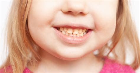 overbite      treatments