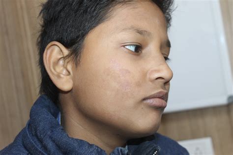 case  papuloneurotic tuberculid cutaneous tuberculosis showing