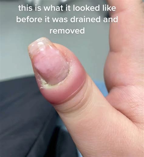 I gave myself a manicure — and ended up in the emergency room