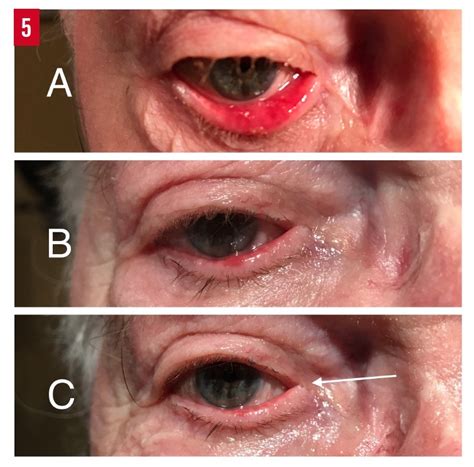 Ectropion: Classification, Diagnosis, and Management | Consultant360