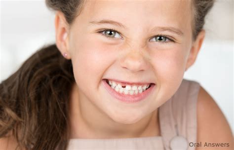 Congenitally Missing Teeth: Why It Happens and How to Treat It | Oral