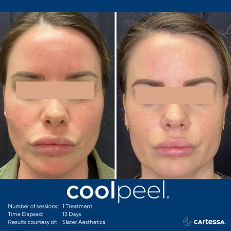 Cool Peel / CO2 Laser | Atlantic Aesthetics Maine