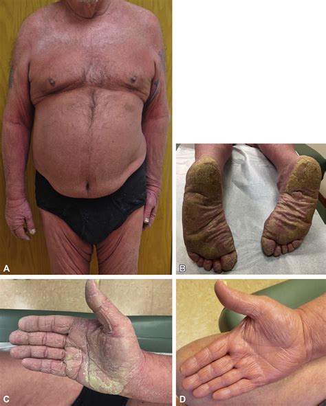 Pityriasis rubra pilaris–like erythroderma in the setting of