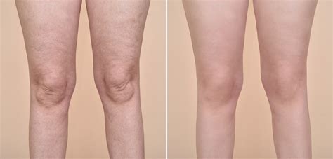Endermologia Antes E Depois - Endermologia - dermomasaż, pozbądź się cellulitu i ujędrnij ciało.