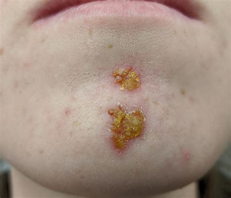 impetigo geeky medics