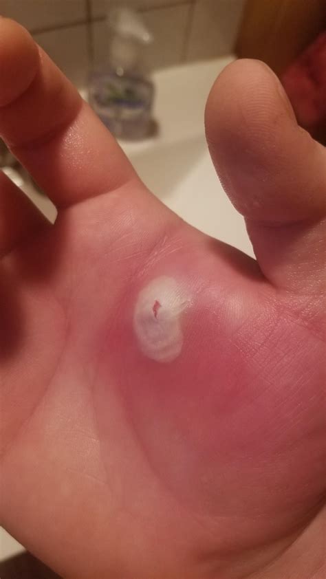 Is this normal for a healing boil? : r/medical